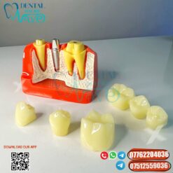 Implant - Crown & Bridge Model
