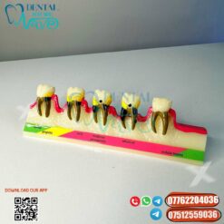Teeth Model Dental Periodontal Disease Pathological 5 Stages Progress