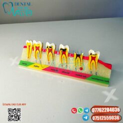 Dental Caries Developing Model