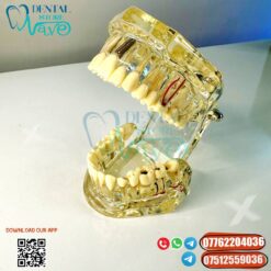 Transparent Disease Teeth Model, Clear Dental Implant Teeth Model Dentist Standard Removable Tooth Pathological Teaching Model