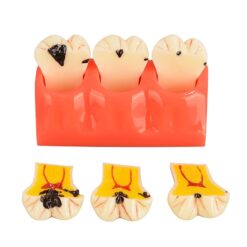 Dental Caries Teeth Model 4 Times Dental Tooth Decay Model Caries Bilateral Comparison