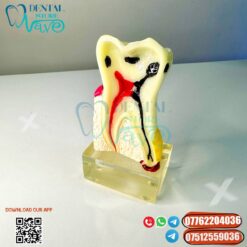 Tooth Anatomy Model With Dental Caries